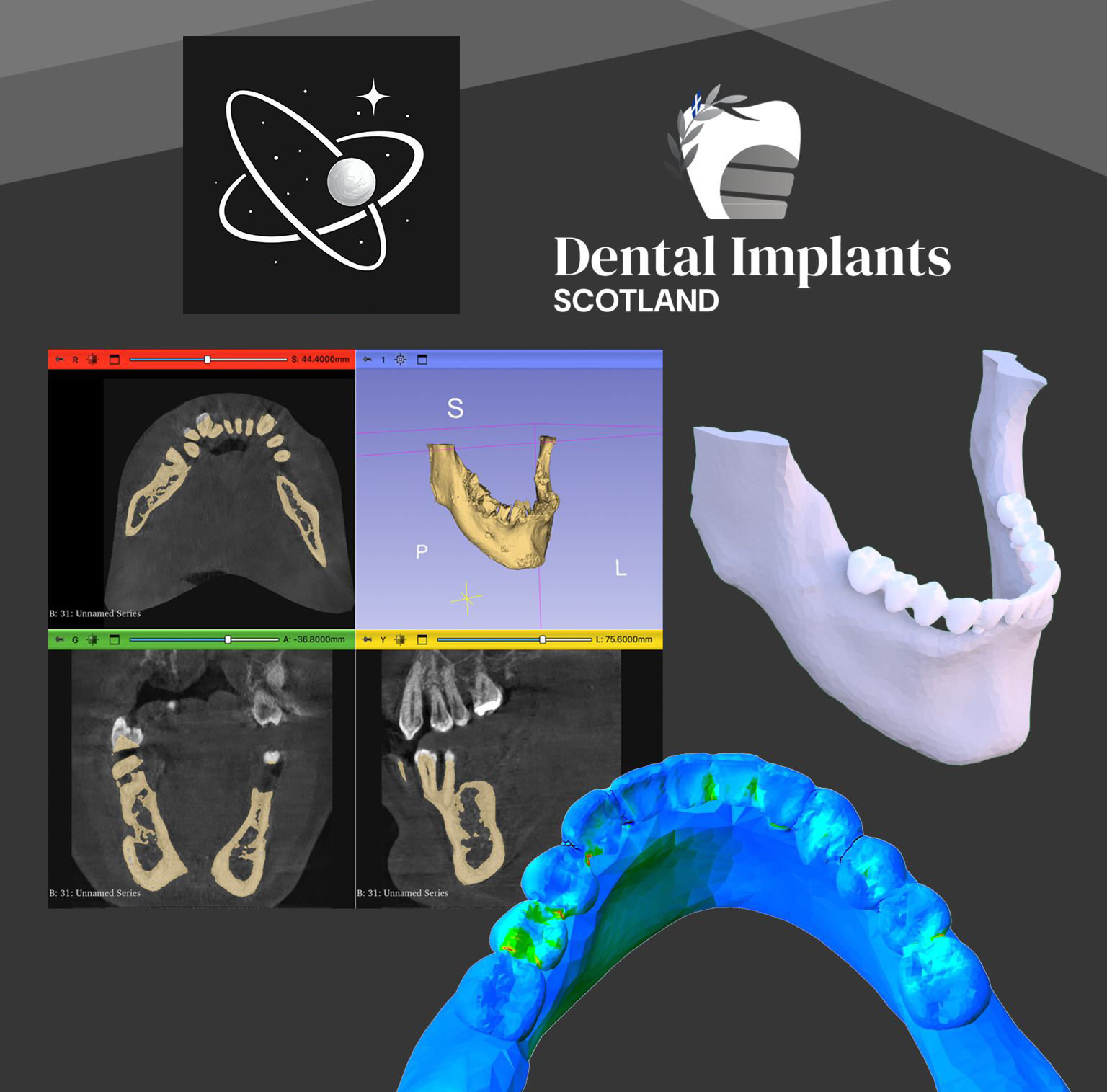 Dental Implants Scotland study preview