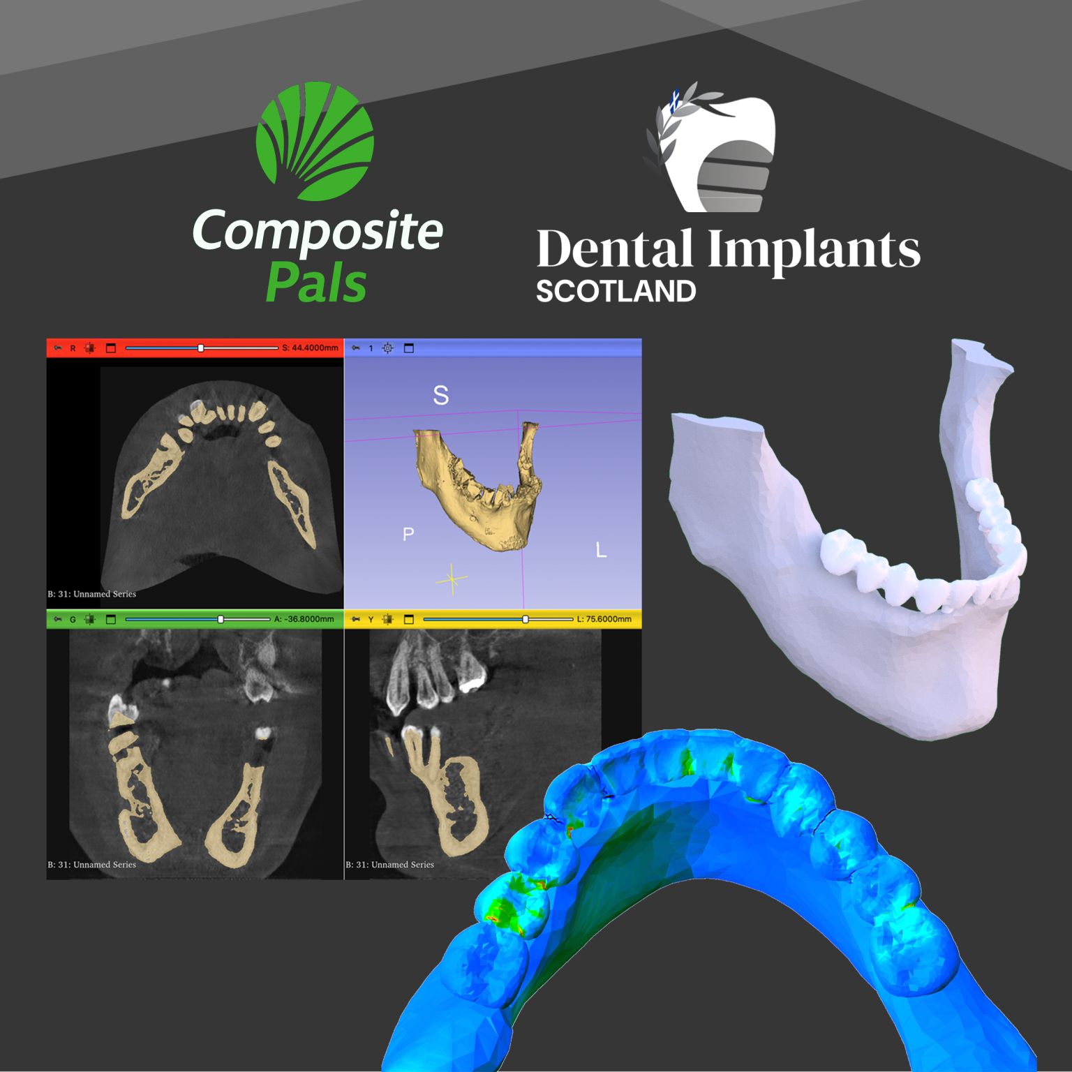 Dental Implants Scotland study preview